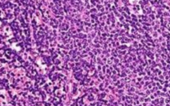 Imagen de las células de la leucemia, combatidas por las de sangre de cordón umbilical.